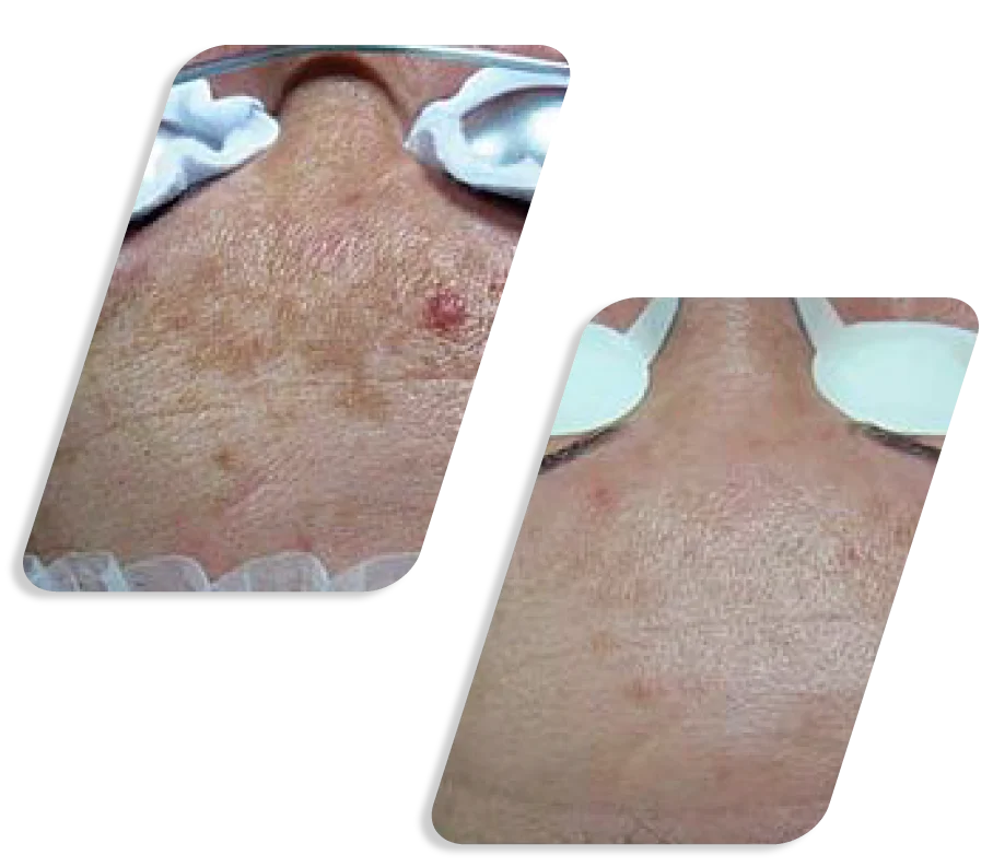 Q Switch Lazer Before After