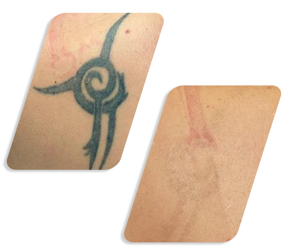 Q Switch Lazer Before After