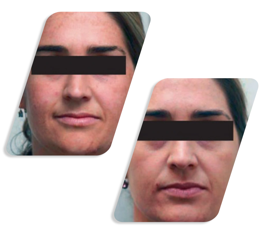 Q Switch Lazer Before After