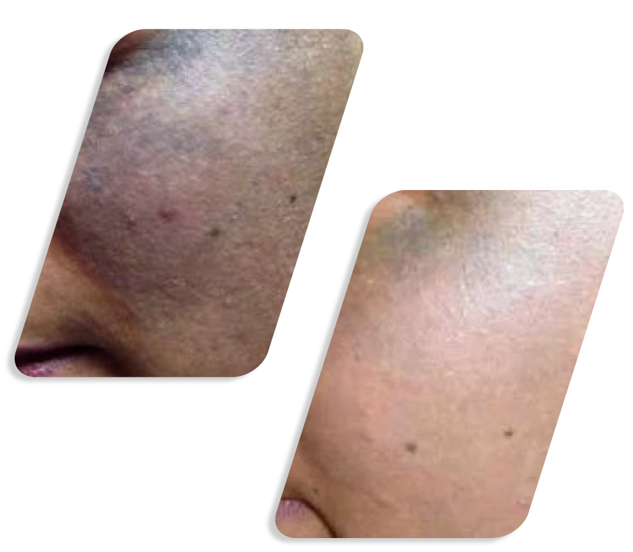 Q Switch Lazer Before After