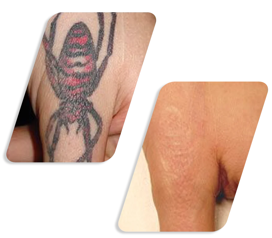 Q Switch Lazer Before After