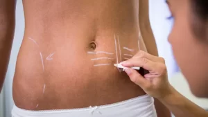 Абдоминопластика