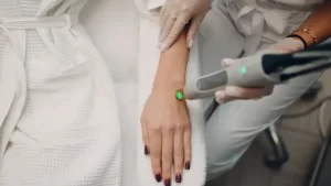 Leke tedavisinde Q-switch Lazer uygulanan kadın