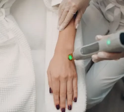 Leke tedavisinde Q-switch Lazer uygulanan kadın