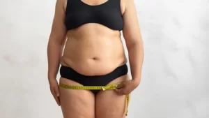 Lipödem Ameliyatı Riskleri şişman kadın