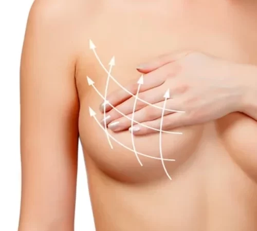 Breast Lift
