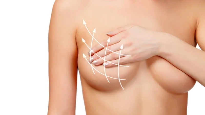 Breast Lift