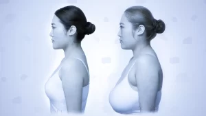 Breast Reduction