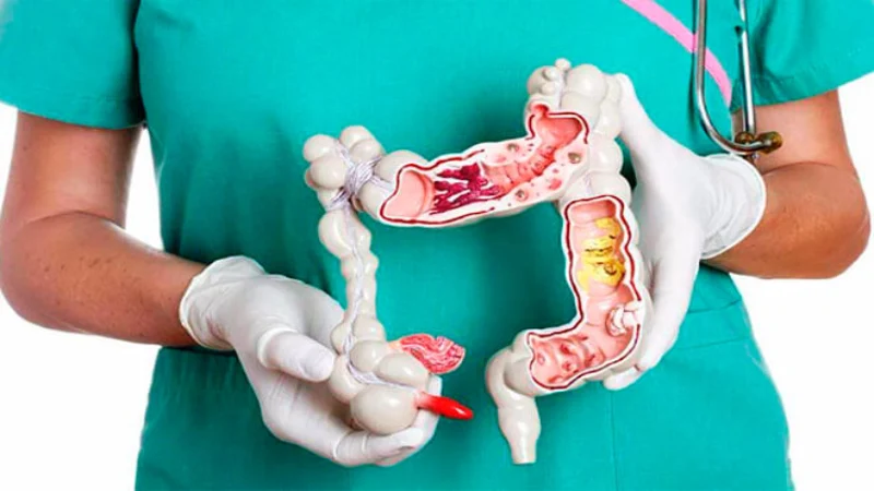 bağırsak-polipleri