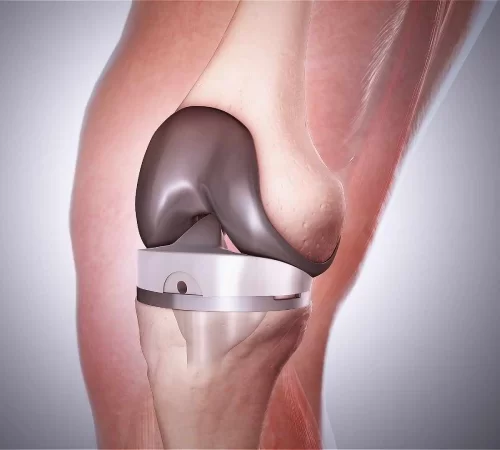 Diz Protezi Ameliyatı