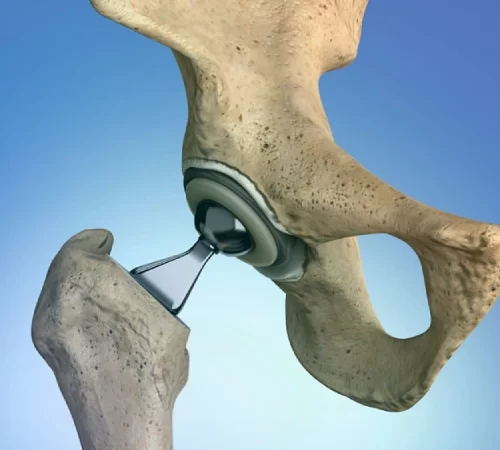Kalça Protezi