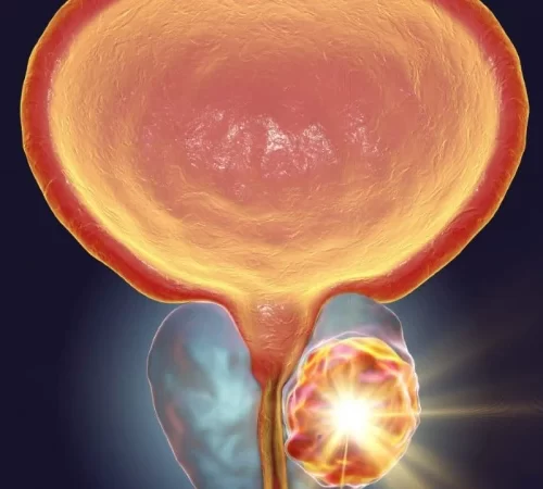 rezum prostate enlargement