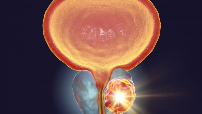 rezum prostate enlargement