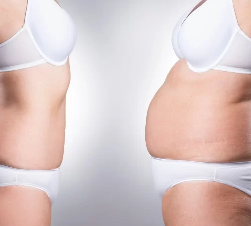 Kilo Verme Sonrası Estetik Ameliyatları