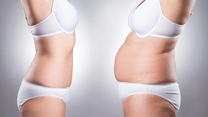 Kilo Verme Sonrası Estetik Ameliyatları