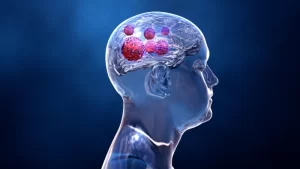 Beyin Tümörü Nedir? Çeşitleri Nelerdir?- Tümöre sahip olan beyin resmi