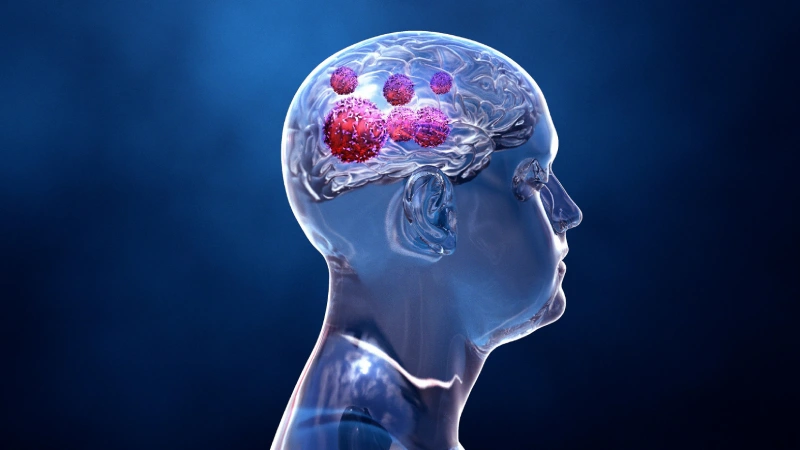 Beyin Tümörü Nedir? Çeşitleri Nelerdir?- Tümöre sahip olan beyin resmi