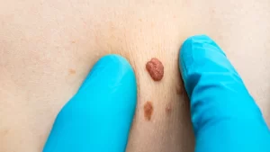 Et Beni (Skin Tag)/Nedir? Et Beni Aldırma?- et beni ve doktor eli