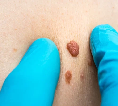 Et Beni (Skin Tag)/Nedir? Et Beni Aldırma?- et beni ve doktor eli