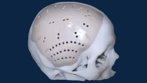 Kranioplasti Nedir?- implant takılmış beyin görseli