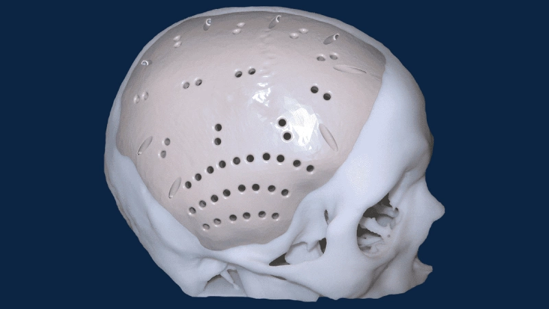 Kranioplasti Nedir?- implant takılmış beyin görseli