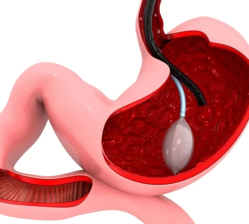 Предимствата, рискове и странични ефекти при стомашния балон