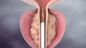 Rezum Tedavisi Yan Etkileri- prostat