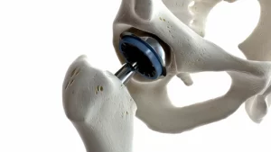 Çimentosuz Kalça Protezi Nedir? - protezin iskete uygulanmış hali