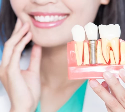 Kemik Grefti Nedir? - implant ve çene bağlantısını gösteren resim
