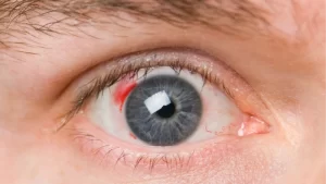 Vitrektomi Nedir? Hangi Sorunları Tedavi Eder? - göz kanaması olan göz