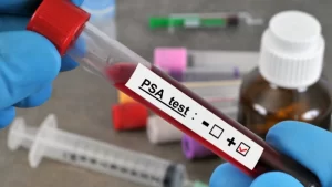 Yaşlara Göre PSA Değerleri - PSA testi