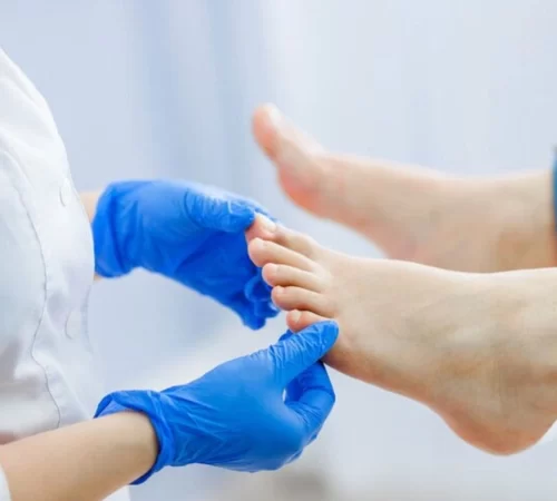 bunion surgery