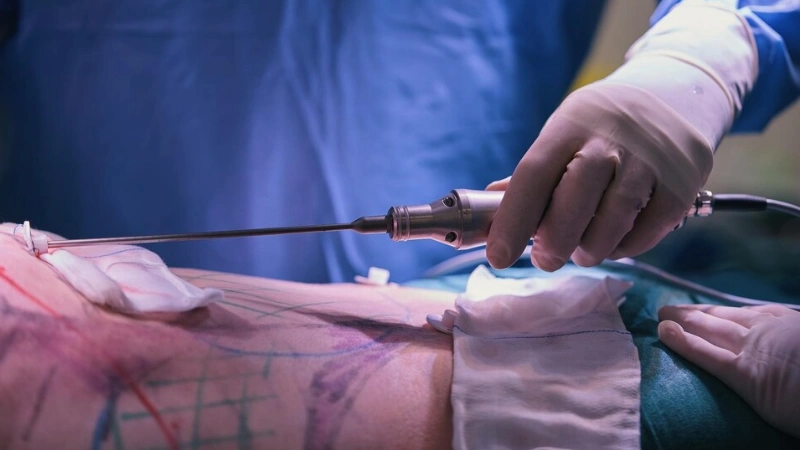 liposuction or lipomatic