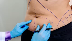 Lipomatik Avantajları Nelerdir?