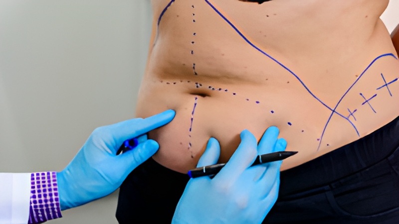 Lipomatik Avantajları Nelerdir?