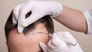 hair transplant Istanbul
