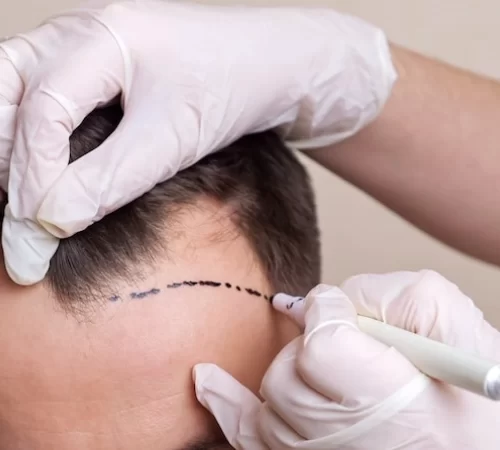hair-transplant-Istanbul hair transplant Istanbul