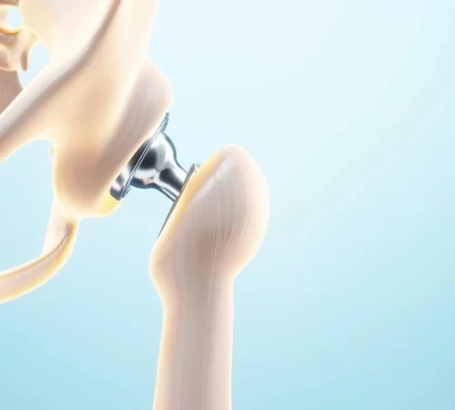 hip-replacement-in-turkey hip replacement in turkey