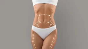 laser liposuction in turkey