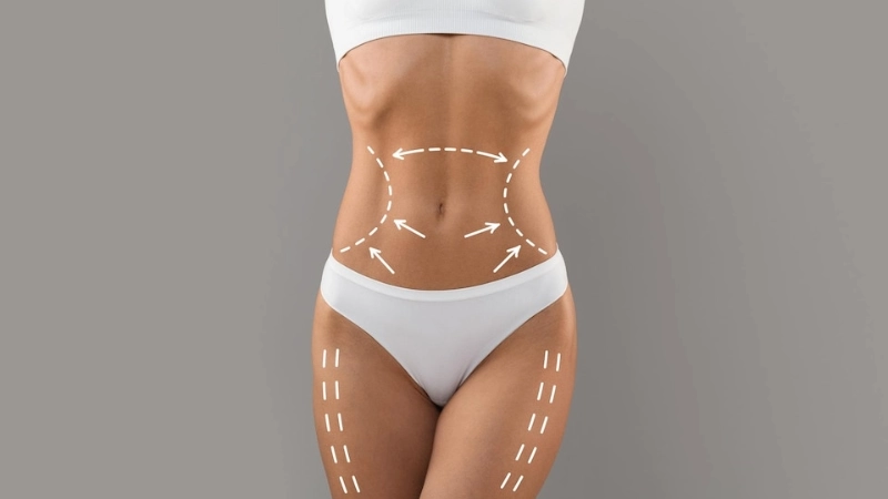 laser liposuction in turkey