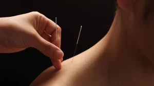Akupunktur Tedavisi