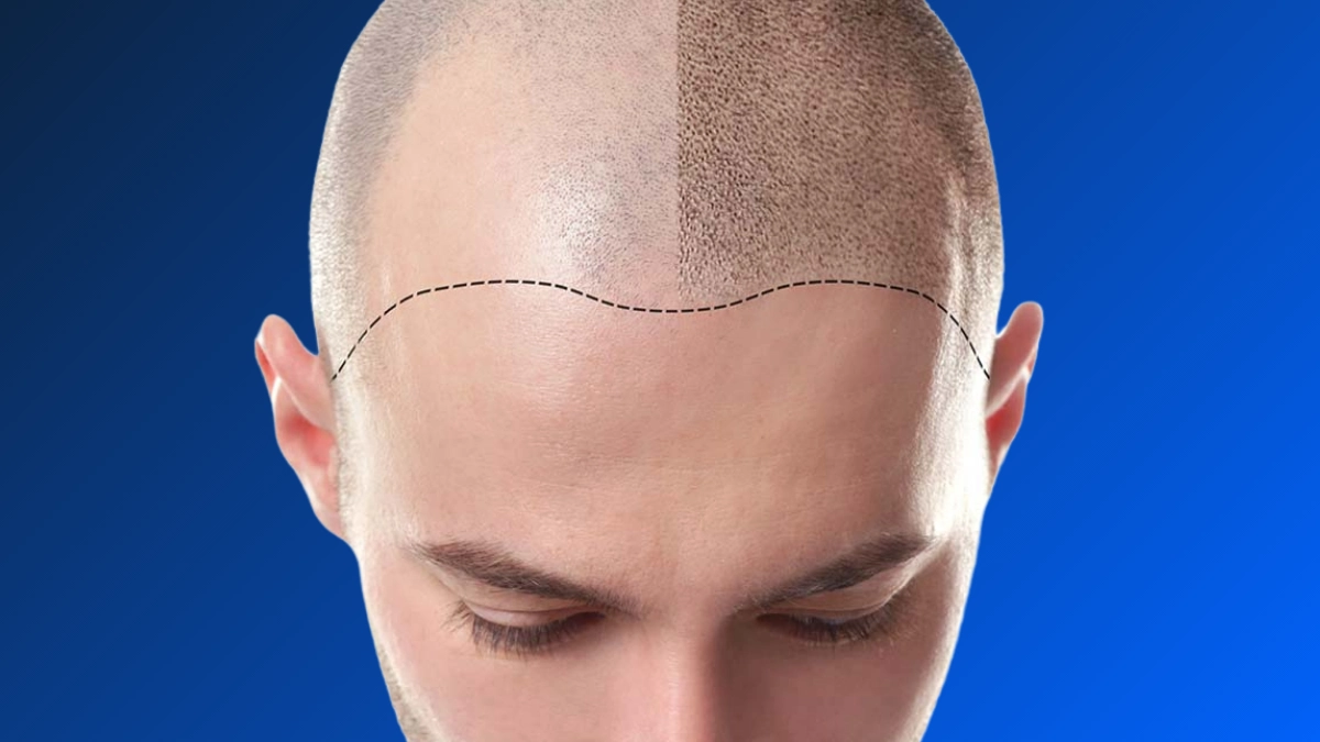 Saç Ekimi ile Alın Daraltma