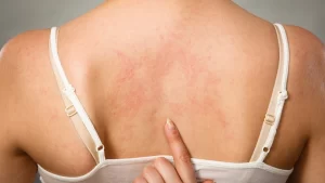 Civatte Poikiloderma Tedavisi