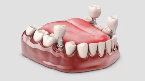 Dental Implants in Istanbul
