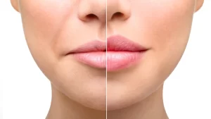 Dolgu Eritme İşlemi Nedir? Nasıl Yapılır?