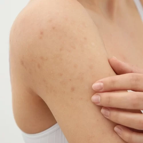 Liken Planus Nedir?