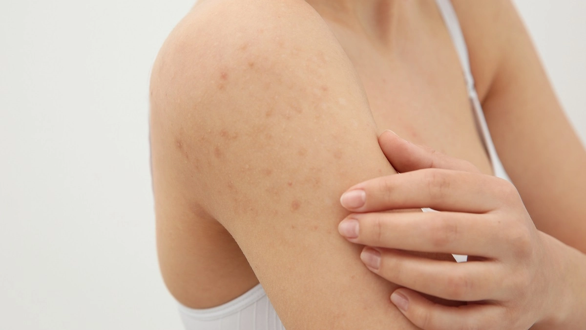 Liken Planus Nedir?