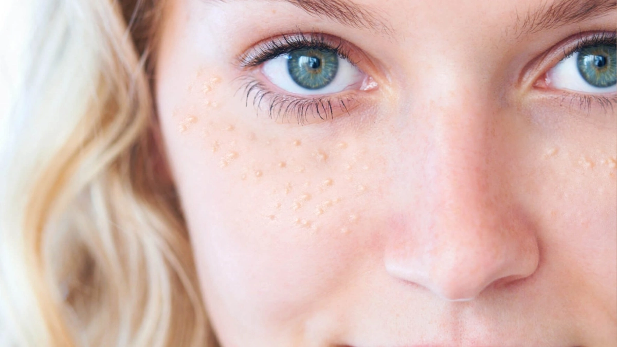 Milia Tedavisi (Göz Altı Yağ Bezesi)