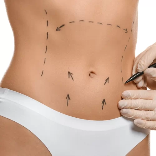 Operația Mommy Makeover în Turcia