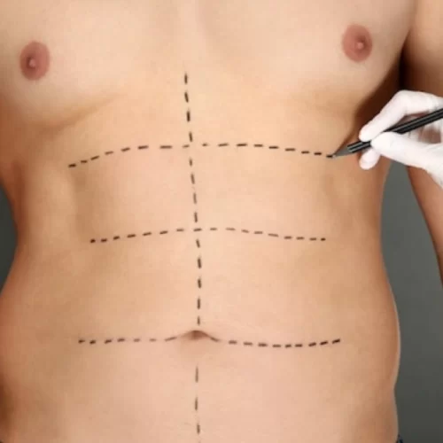Six Pack Surgery in Turkey